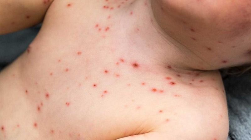 DSP Covasna: „Cazurile de rujeolă au scăzut semnificativ în acest an”