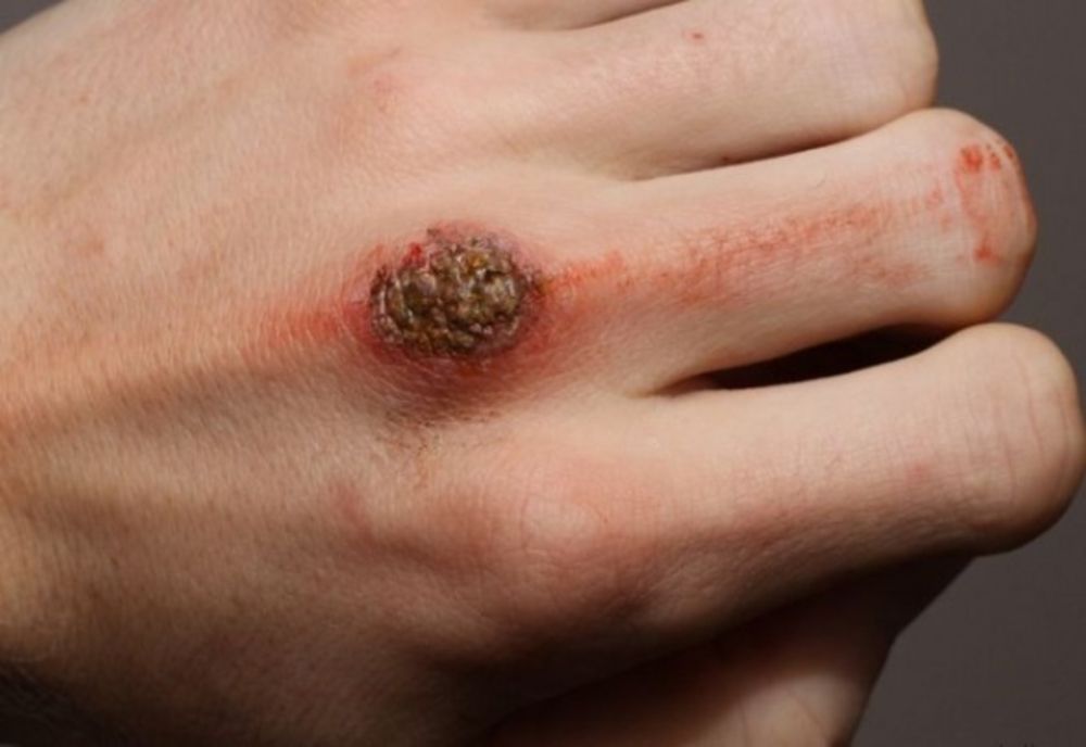 Focar de râie într-un cartier din Sfântu Gheorghe. DSP Covasna a luat primele măsuri pentru a preveni epidemia