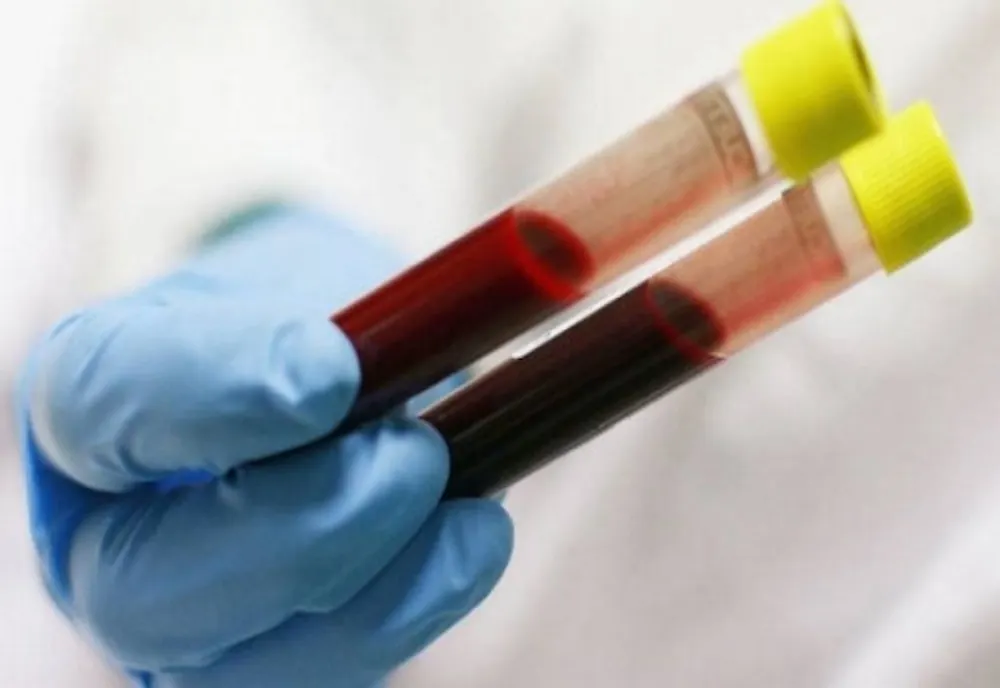 123 de covăsneni infectaţi cu coronavirus. Numărul total al infecţiilor a ajuns la 6633 în România