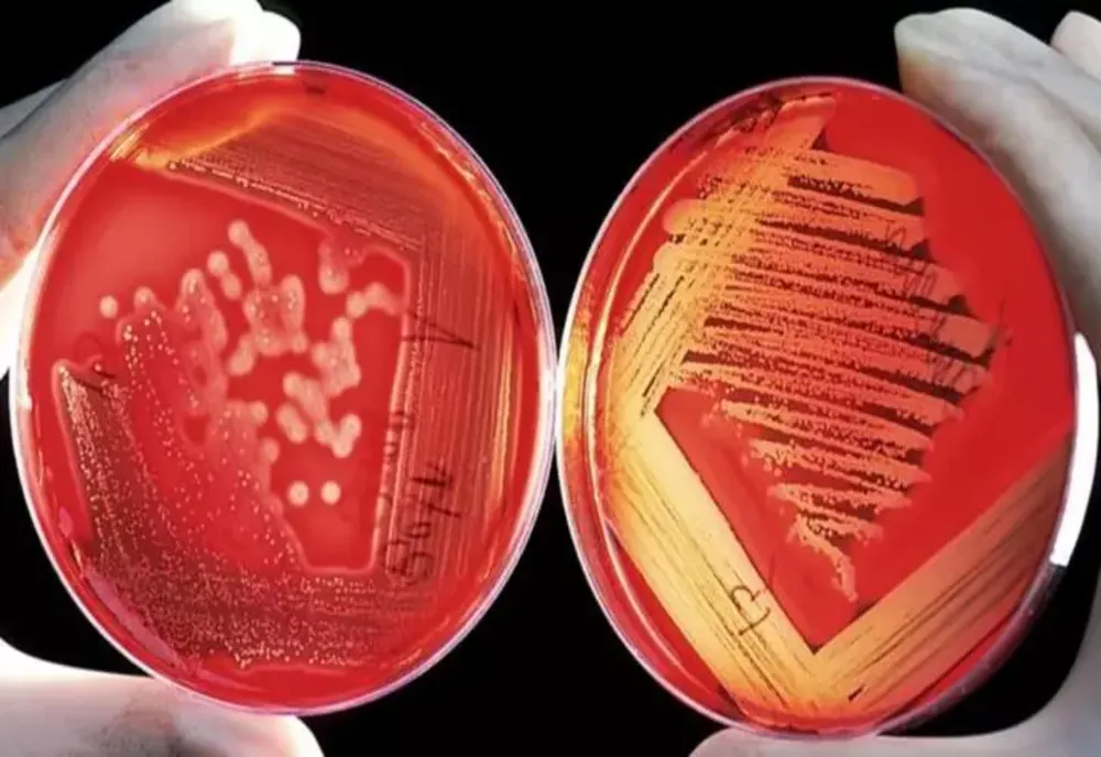 Infecția creierului pentru care nu există tratament. Doar 4 oameni i-au supraviețuit până acum