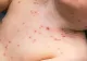 Județul Covasna, pregătit cu aproximativ 2.000 de doze de vaccin antirujeolic
