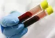 123 de covăsneni infectaţi cu coronavirus. Numărul total al infecţiilor a ajuns la 6633 în România